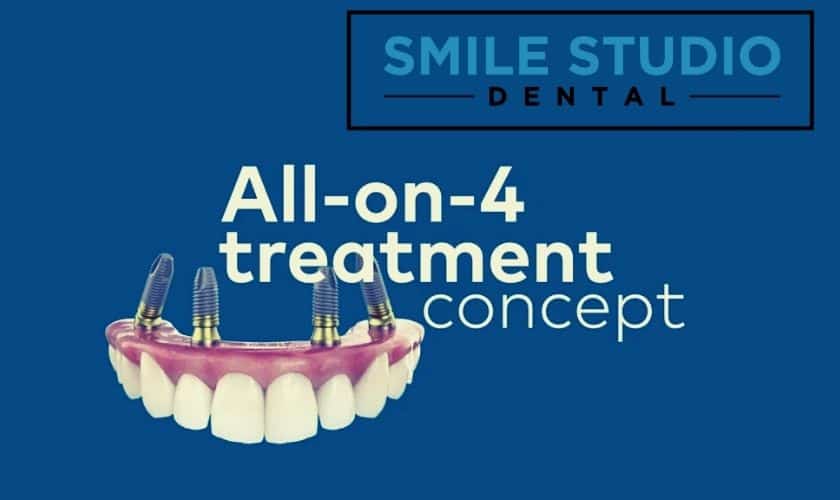 How To Place All-On-4 Dental Implants?