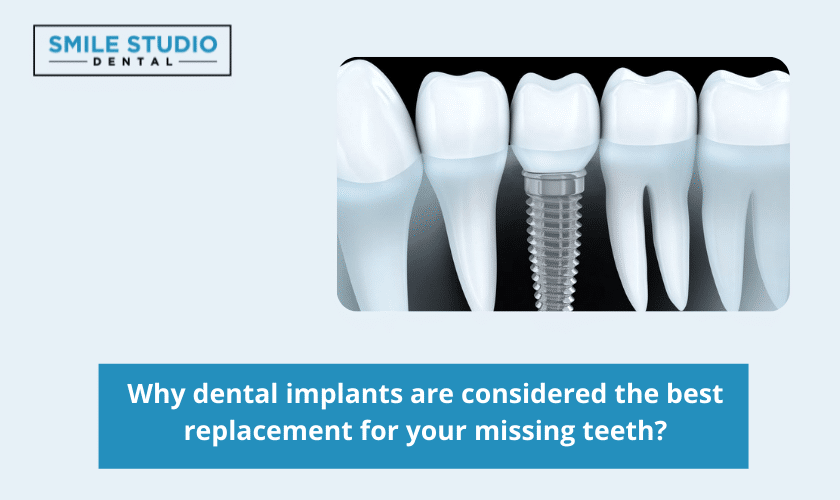 Why dental implants are considered the best replacement for your missing teeth?