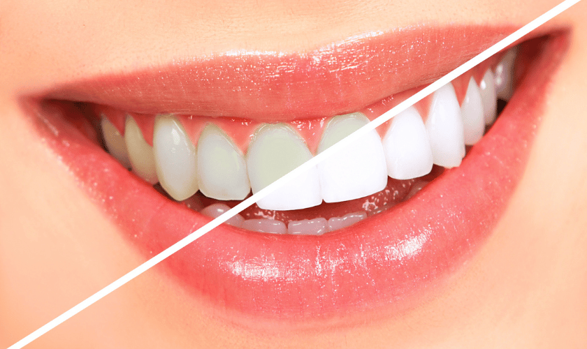 The Advanced Guide to Teeth Whitening