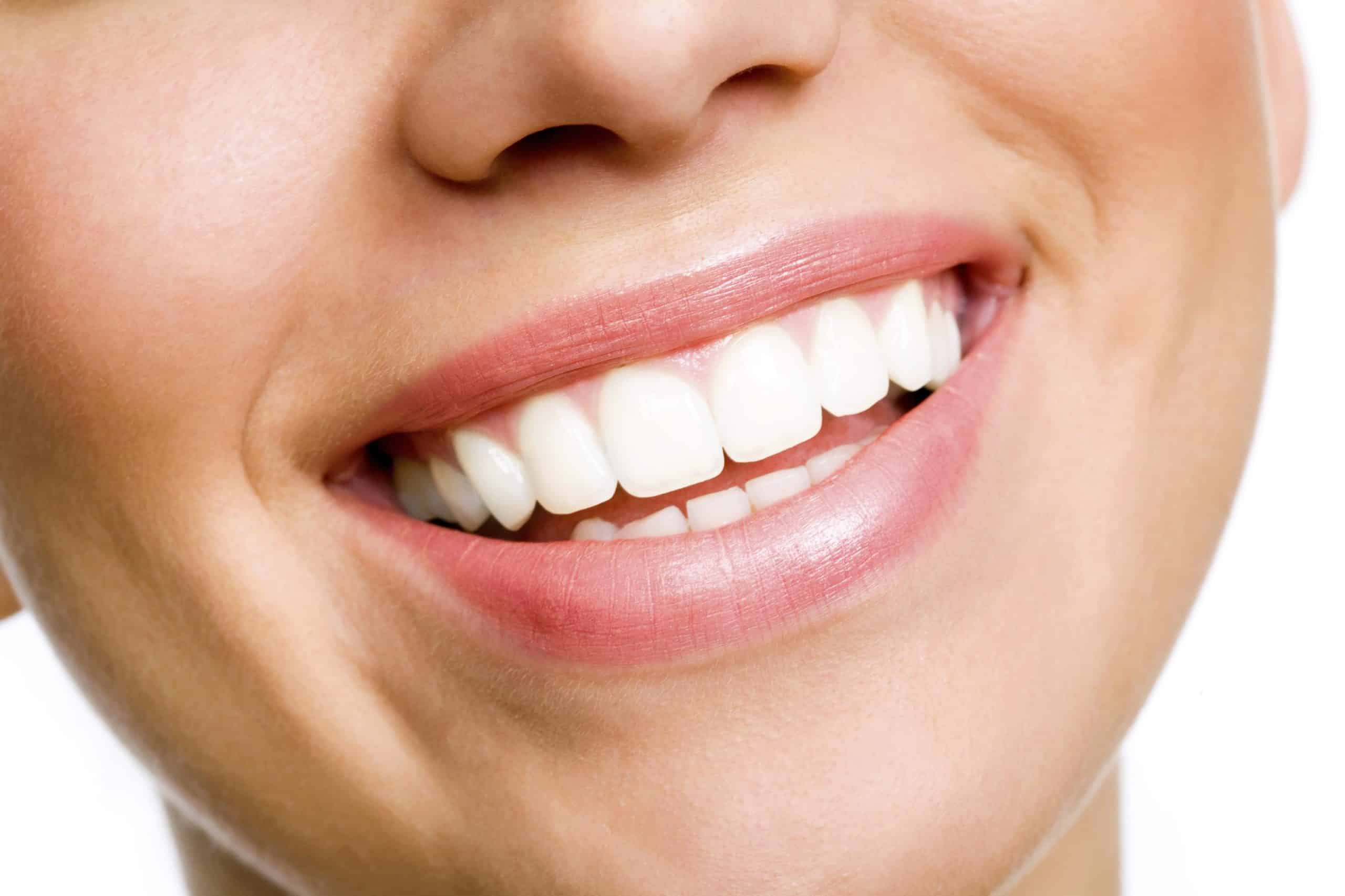 Why is Teeth Whitening Important? 5 things You Should Know
