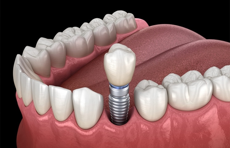 What Is The Best Option For Single Tooth Replacement?
