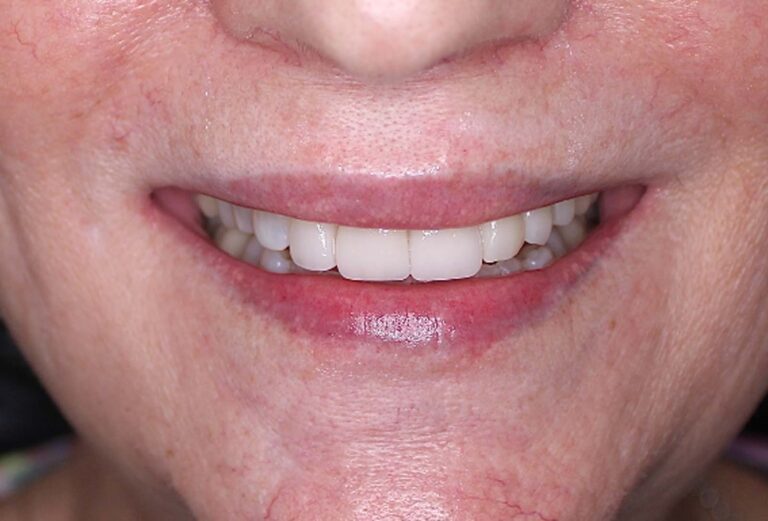 An "after" photo of a woman who got dental veneers and a dental bridge at Smile Studio Dental in Denver, CO.